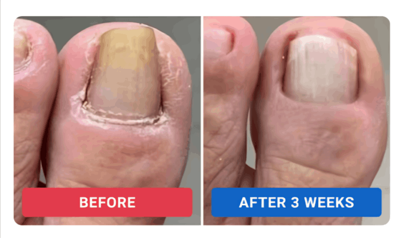 Orvalle Nail Fungus Pen review by Dan R. – Orvalle