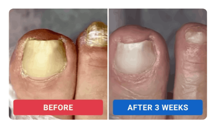 Orvalle Nail Fungus Pen review by Elena S. – Orvalle