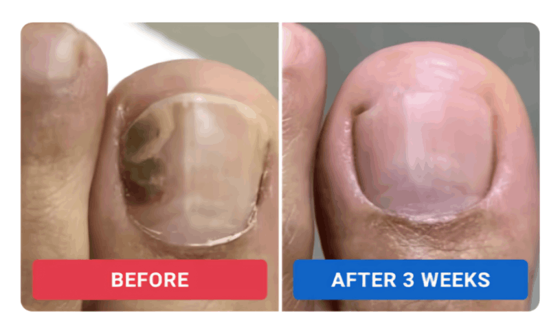 Orvalle Nail Fungus Pen review by Rachel M. – Orvalle