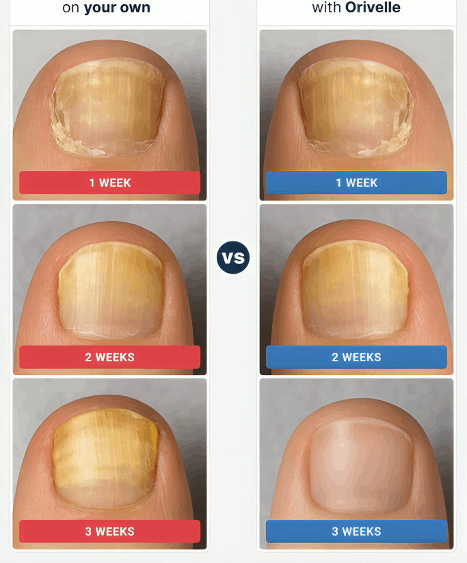 Orvalle Nail Fungus Pen before and after – Orvalle
